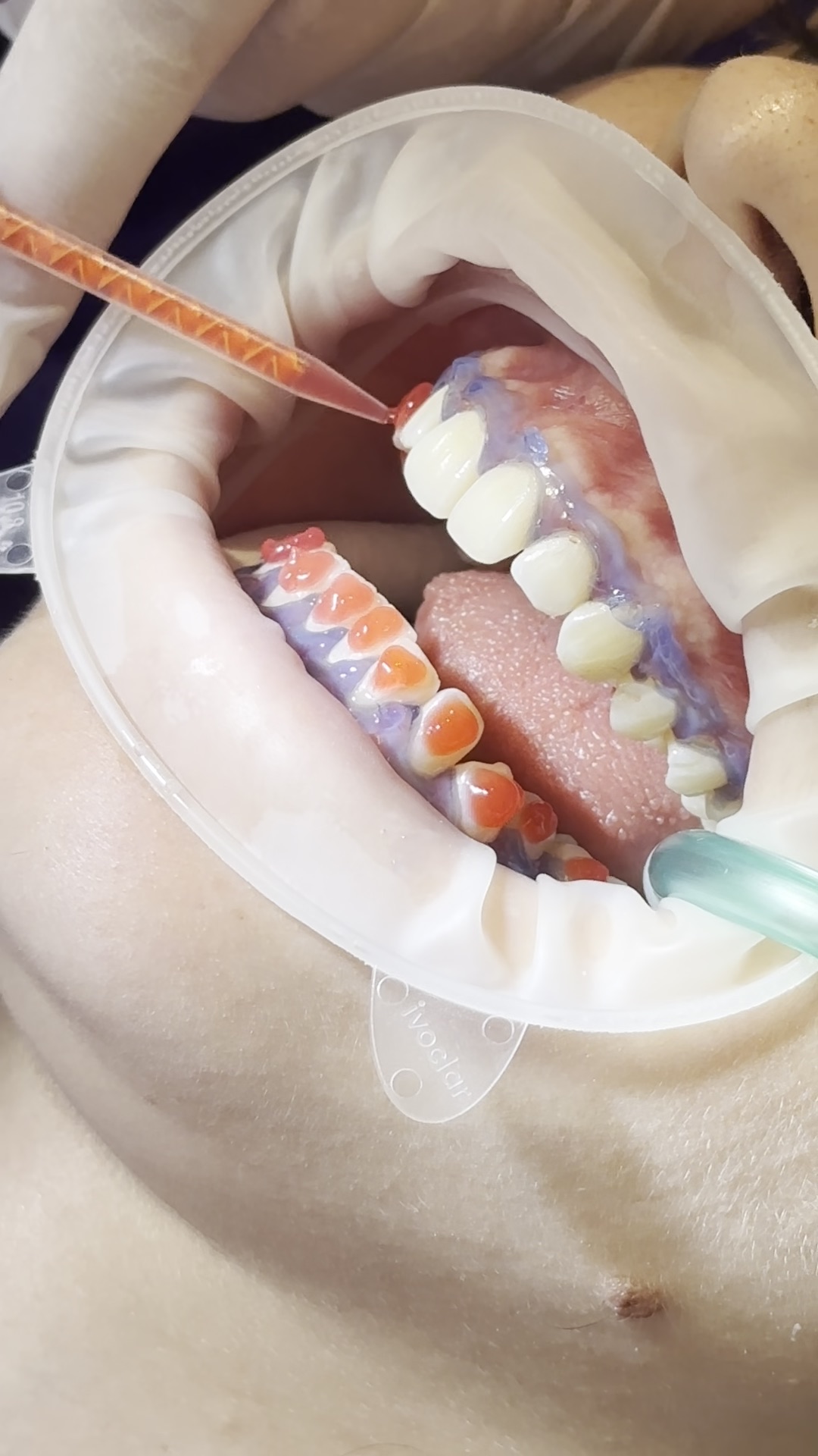 Fogfehérítés a Meditum Dentalban