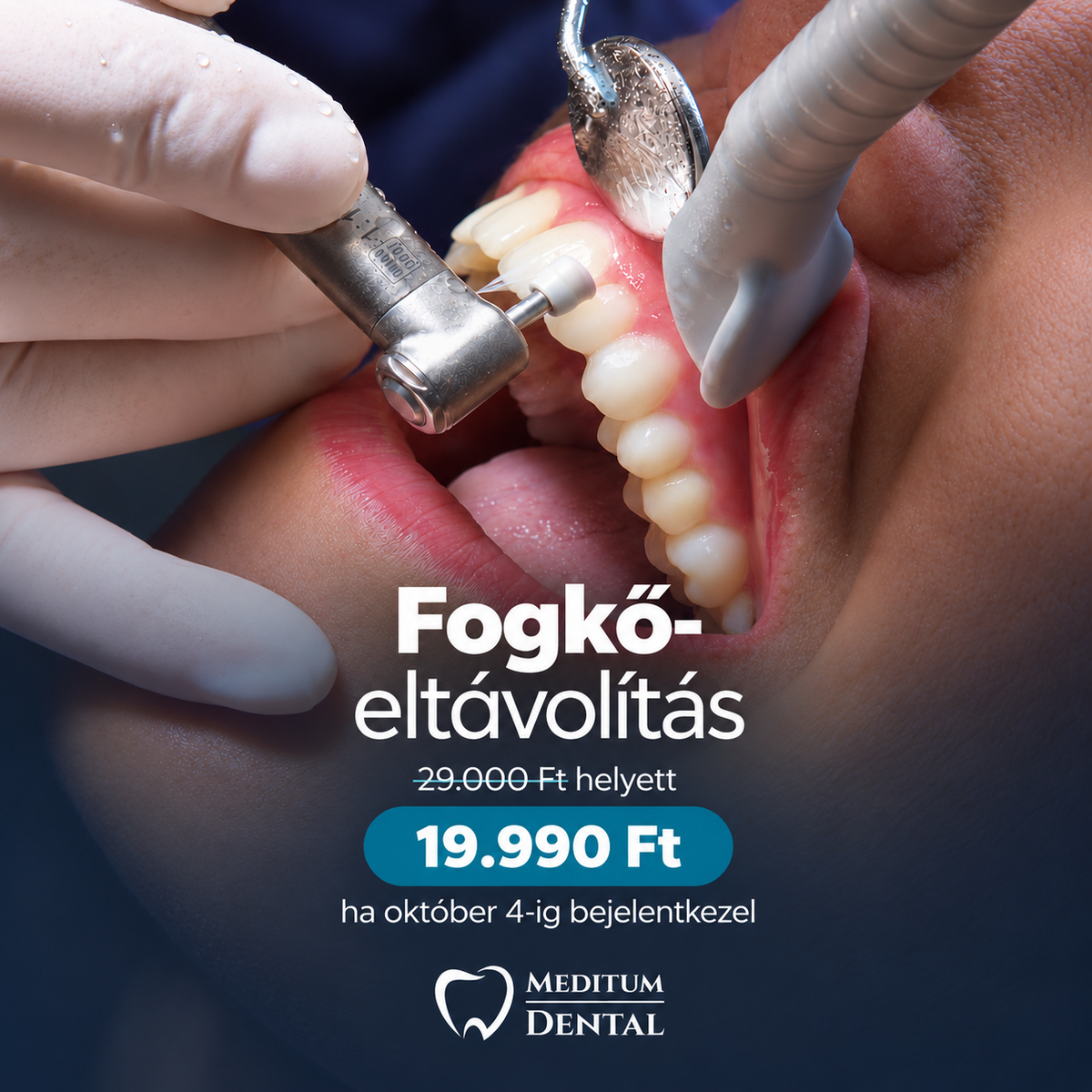 fogkőeltávolítás akció