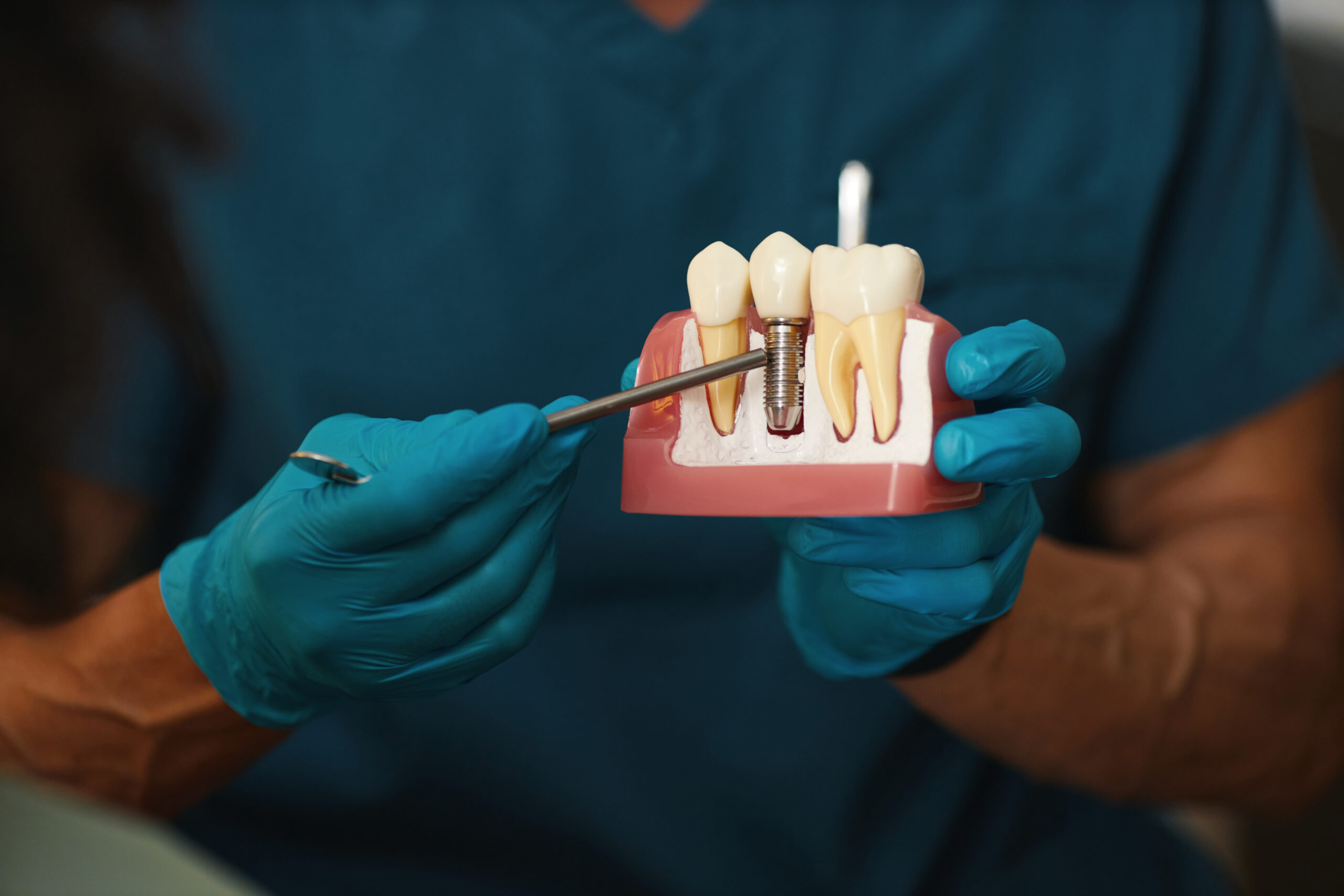 Fogászati implantátum a Meditum Dentalban